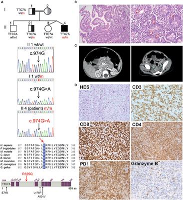 Chronic Intestinal Pseudo-Obstruction and Lymphoproliferative Syndrome as a Novel Phenotype Associated With Tetratricopeptide Repeat Domain 7A Deficiency